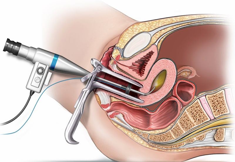 Hysteroscope examining the uterine cavity