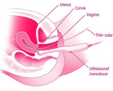 Sonohysterography diagram showing the catheter and ultrasound probe