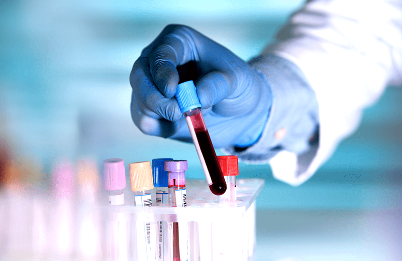 Blood sample for PRP preparation